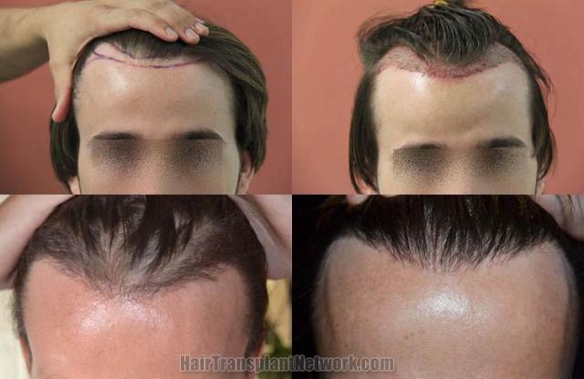 Hair restoration procedure before and after results