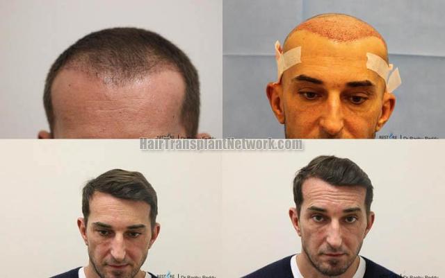 Hair restoration procedure before and after results