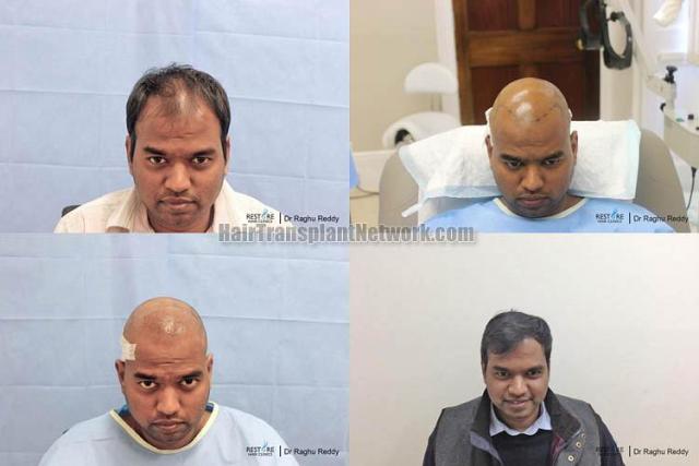 Hair restoration procedure before and after results