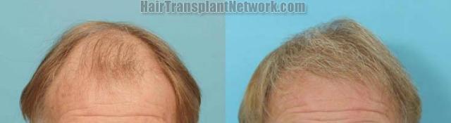 Hair transplantation surgery before and after images