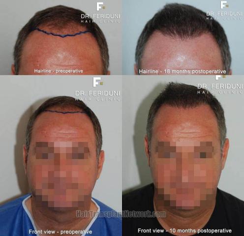 Hair restoration procedure before and after results