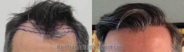 Hair restoration procedure before and after results