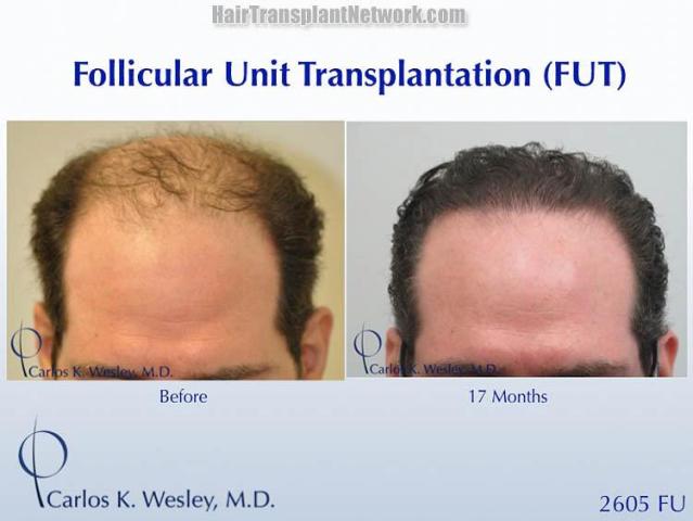 Hair restoration procedure before and after results