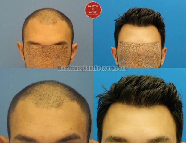 Hair restoration procedure before and after results