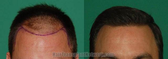 Hair restoration procedure before and after results