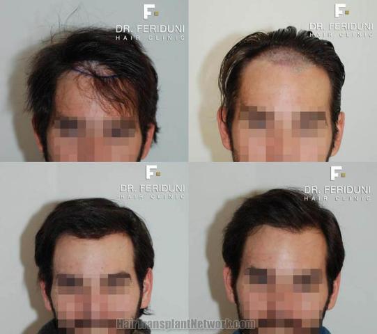 Hair restoration procedure before and after results