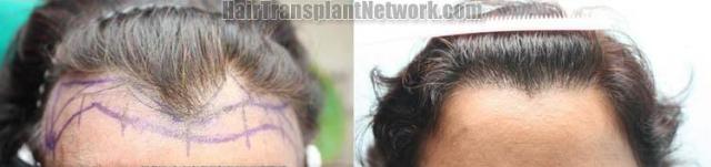 Hair restoration procedure before and after results