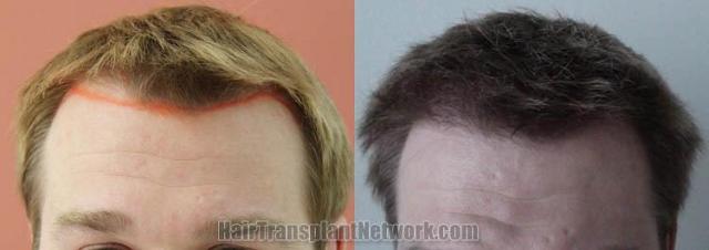 Hair restoration procedure before and after results