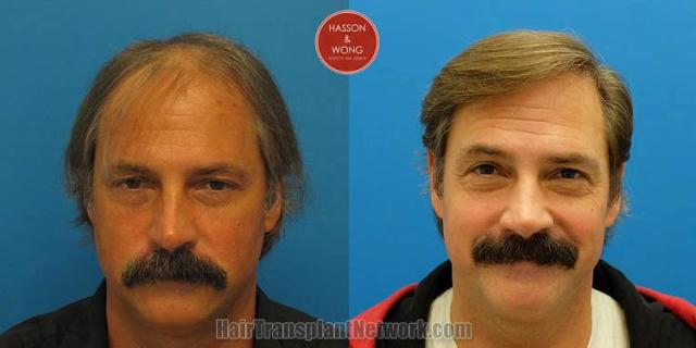 Hair restoration procedure before and after results