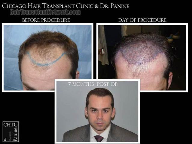 Hair restoration procedure before and after results