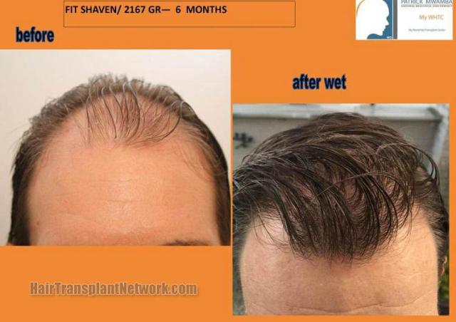 Hair restoration procedure before and after results