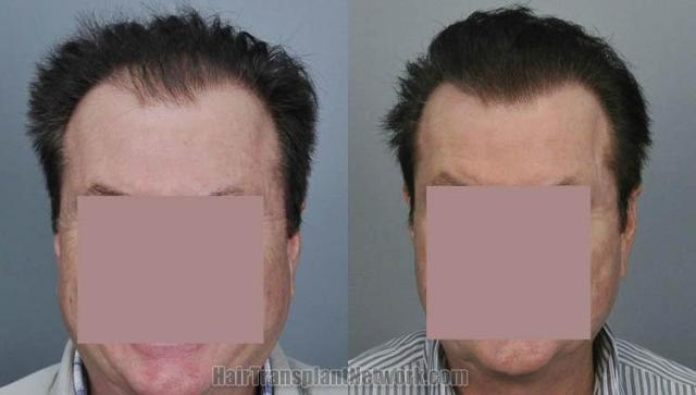 Hair restoration procedure before and after results