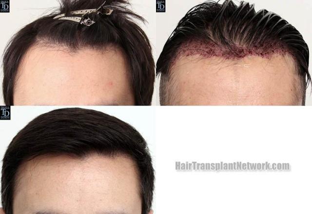 Hair restoration procedure before and after results