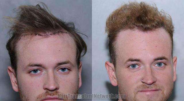 Surgical hair transplantation result photographs