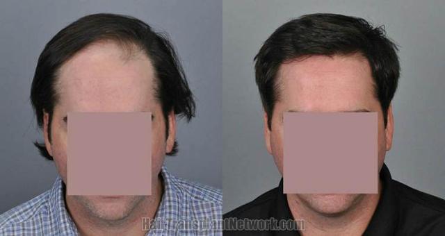 Before and after hair transplantation result photographs