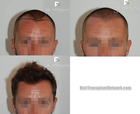 Hair transplantation surgery before and after images