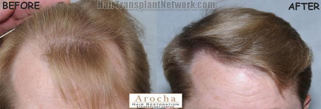 Hair restoration procedure before and after results