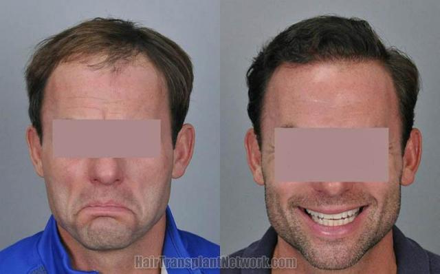 Before and after hair transplant procedure images