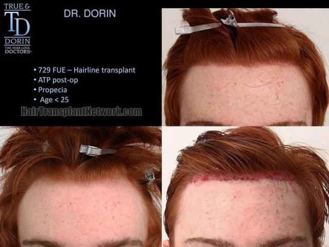 Before and after hair transplant procedure images