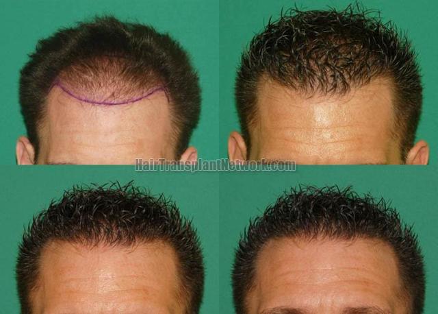 Hair transplantation surgery before and after images