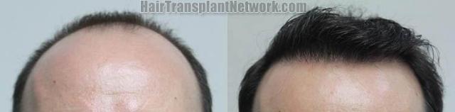 Hair restoration procedure before and after results