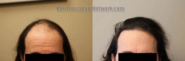 Before and after hair restoration procedure images