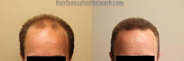 Front view - Before and after hair restoration procedure