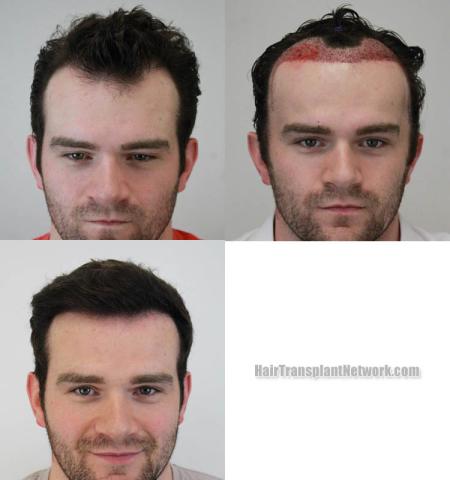 Front view - Before and after hair restoration procedure