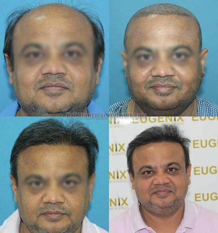 Front view - Before and after hair restoration procedure