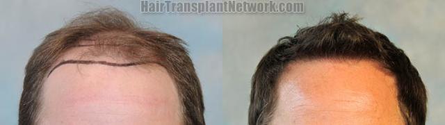 Front view - Before and after hair restoration procedure