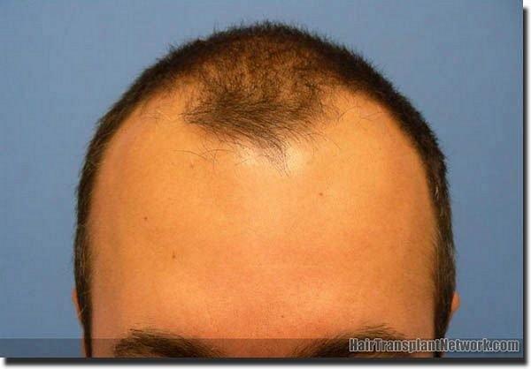 Hair restoration procedure results