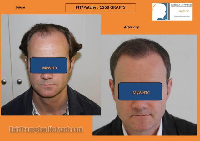 Hair restoration procedure before and after results