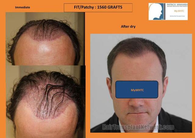 Hair restoration surgery before and after photos