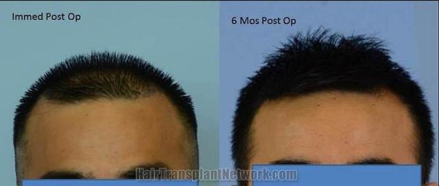 Hair restoration procedure before and after results