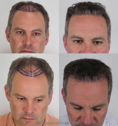 Hair restoration procedure before and after results