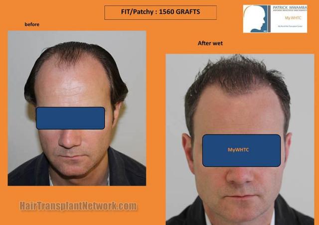 Hair transplantation surgery before and after pictures