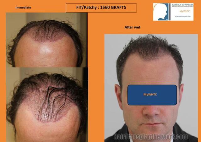 Hair restoration procedure before and after pictures