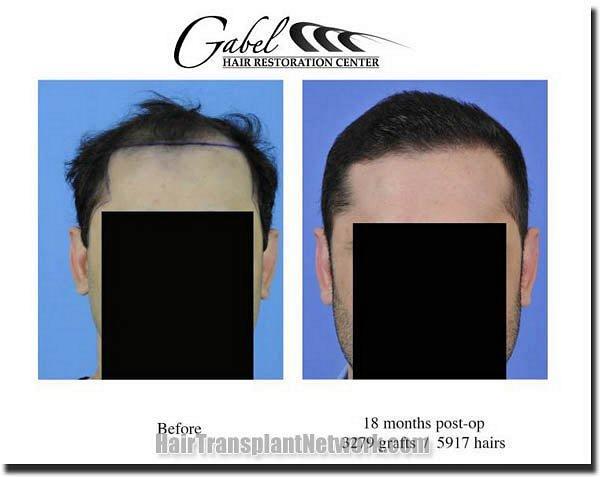 Hair restoration procedure results