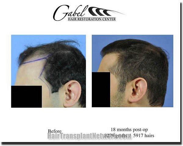 Hair restoration procedure results