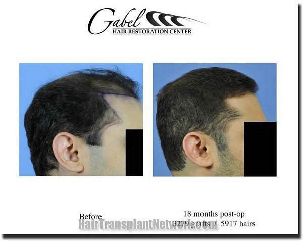 Hair restoration procedure results