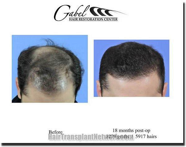 Hair restoration procedure results