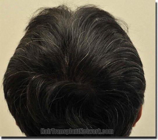 Hair restoration procedure results