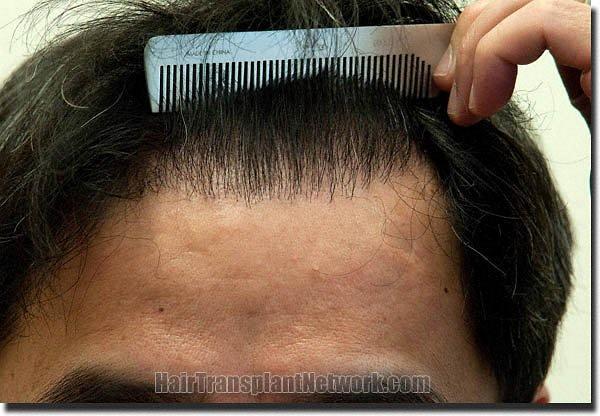 Hair restoration procedure results