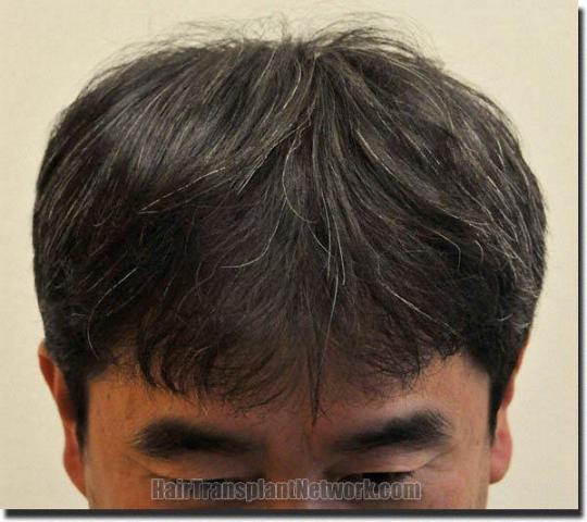 Hair restoration procedure results