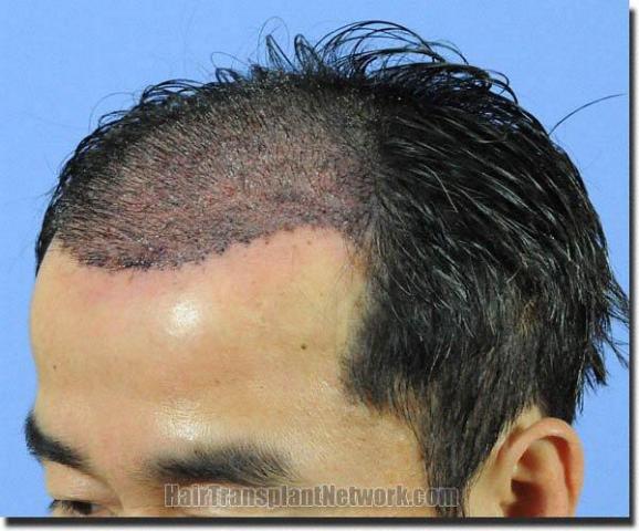 Hair restoration procedure results