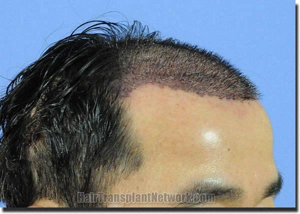 Hair restoration procedure results