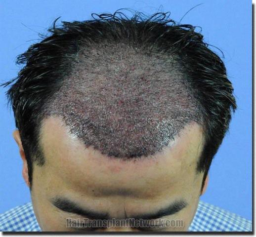 Hair restoration procedure results