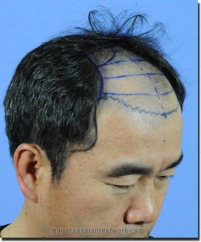 Hair restoration procedure results