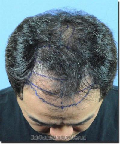 Hair restoration procedure results