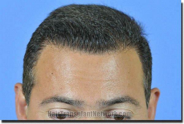 Hair restoration procedure results